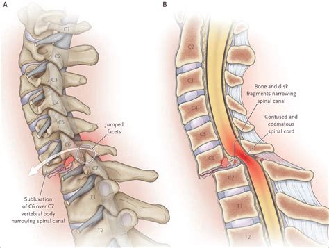 types of spinal cord compression